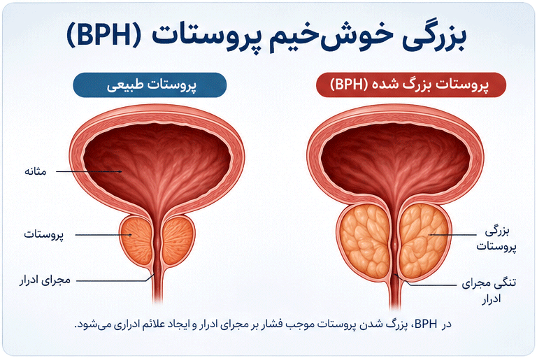آناتومی پروستات طبیعی و پروستات بزرگ شده