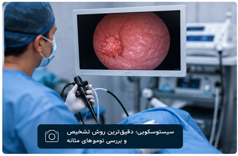 سیستوسکوپی برای تشخیص دقیق سرطان مثانه توسط متخصص کلیه و مجاری ادراری